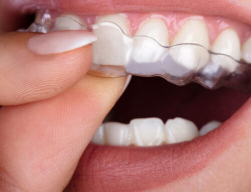 Staying Committed to Your Aligners: Key Tips for Successful Treatment